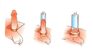 Das Betriebsprinzip der Pumpe, um den Penis zu erhöhen